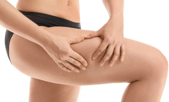 Cellulite